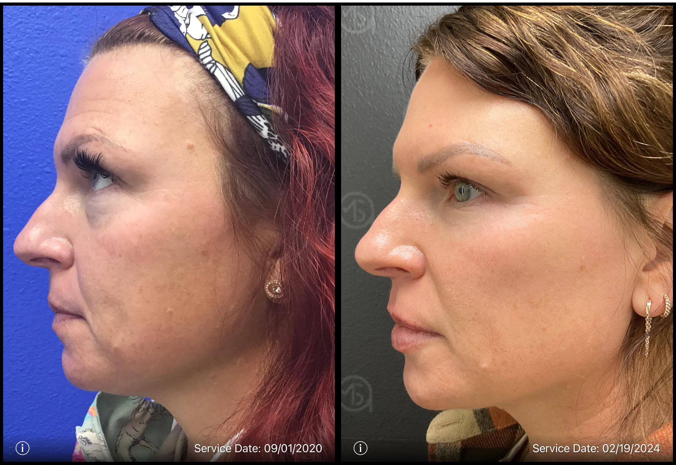 Before and after | skin rejuvenation treatment | ANEU Medical Spa, LLC | McFarland | Madison, WI