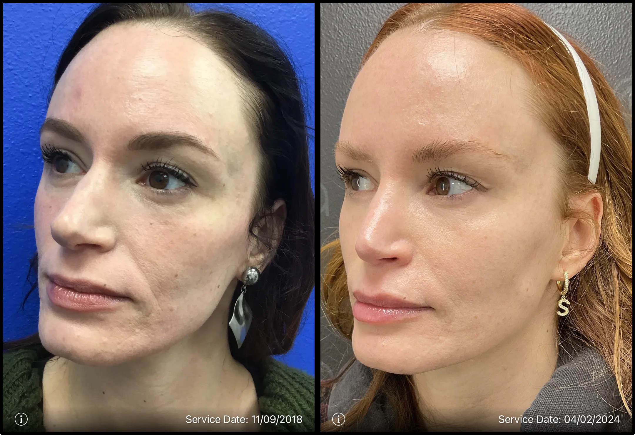 Before and after | skin transformation | ANEU Medical Spa, LLC | McFarland | Madison, WI