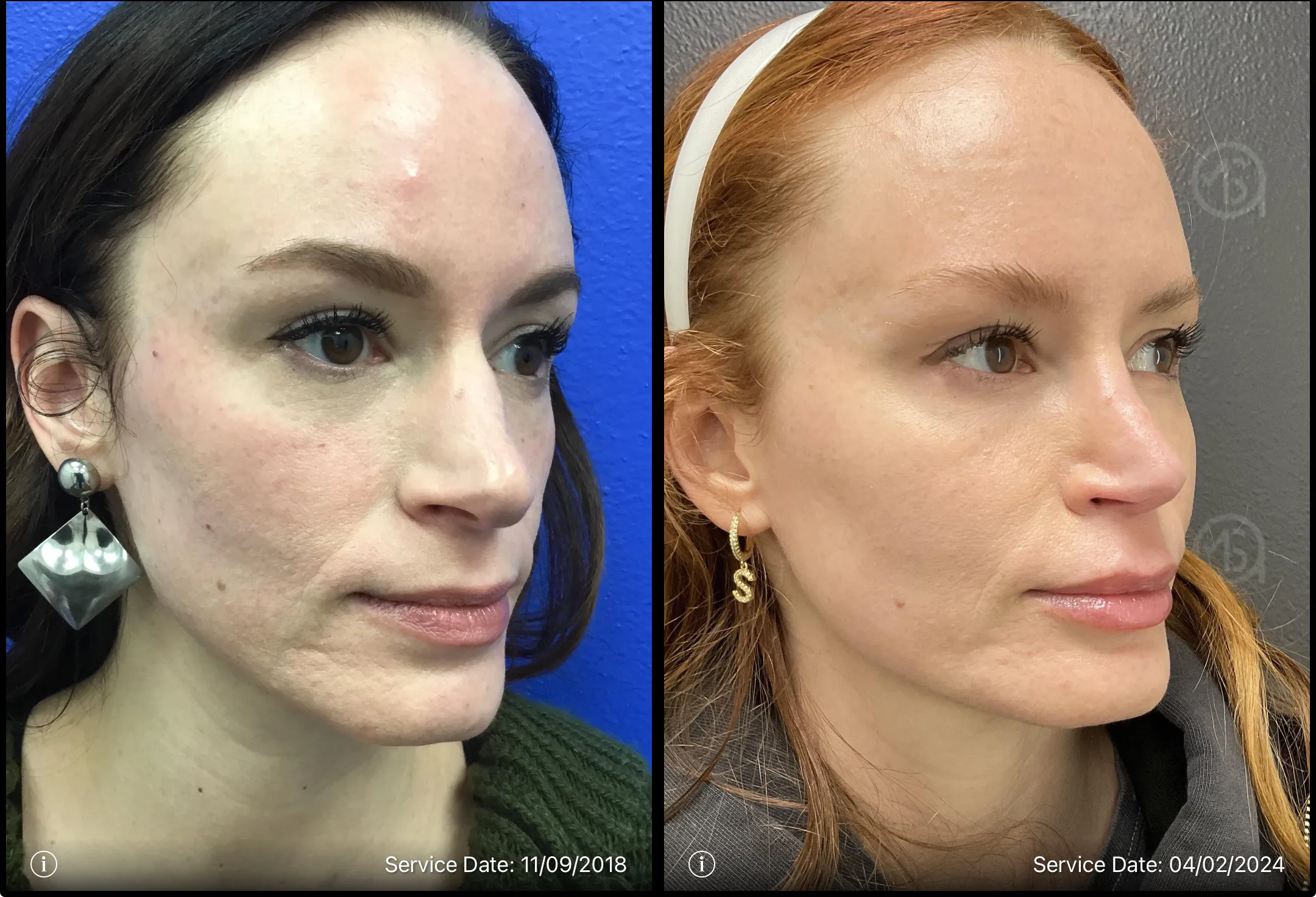 Before and after | acne reduction | ANEU Medical Spa, LLC | McFarland | Madison, WI