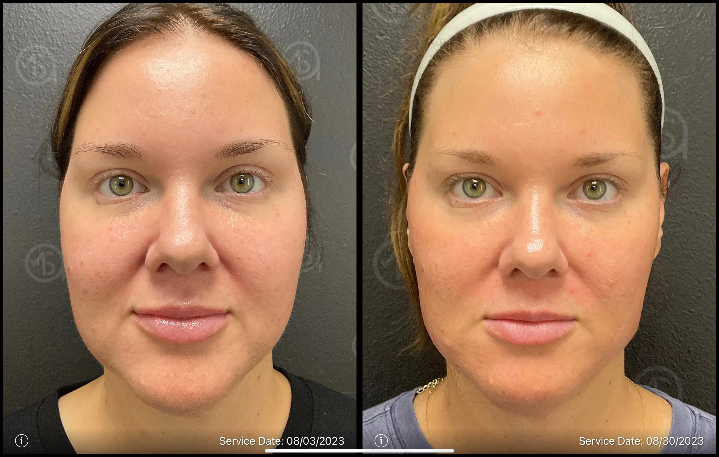Before and after | redness treatment | ANEU Medical Spa, LLC | McFarland | Madison, WI