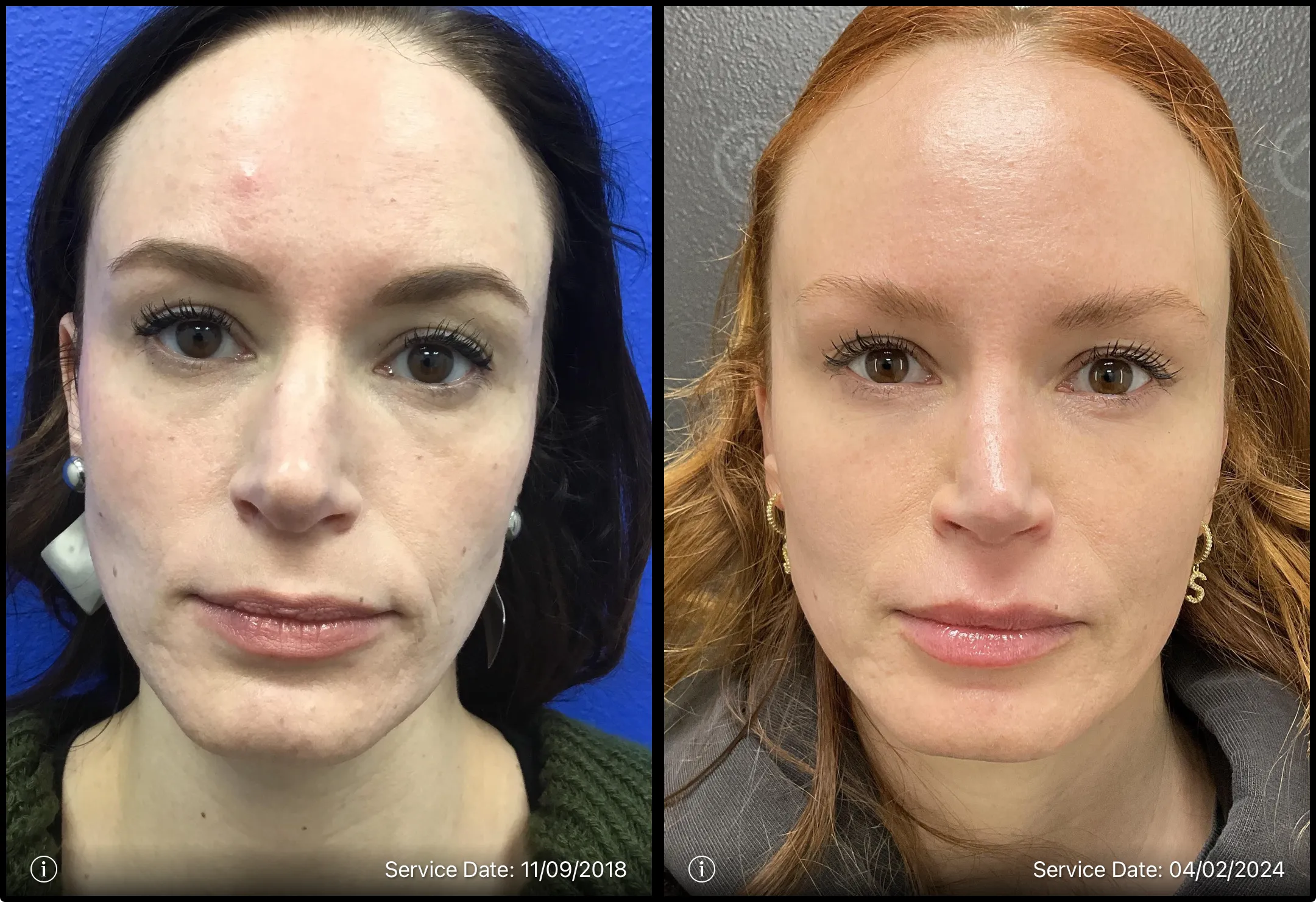 Before and after | professional skin transformation | ANEU Medical Spa, LLC | McFarland | Madison, WI