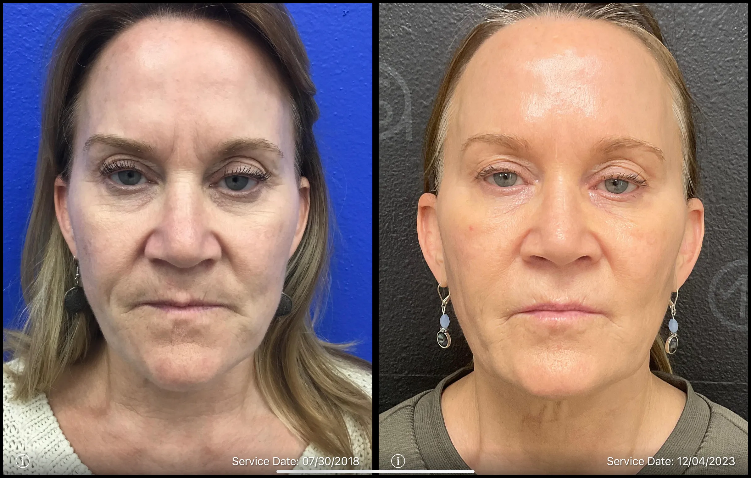 Sculptra Before and after | ANEU Medical Spa, LLC | McFarland | Madison, WI