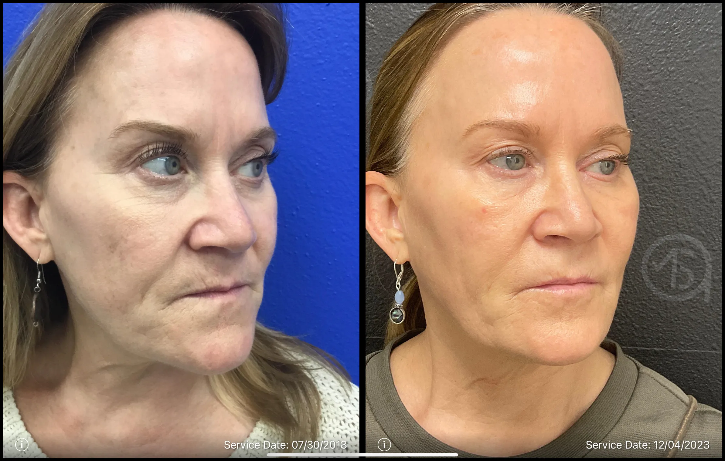 Sculptra treatment | Before and after | ANEU Medical Spa, LLC | McFarland | Madison, WI
