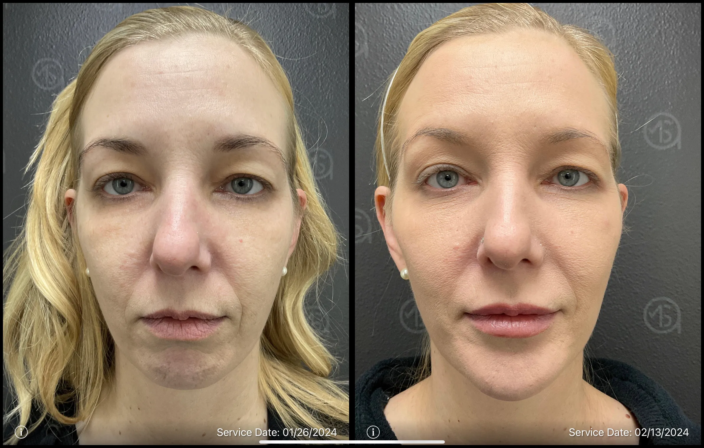 Before and After photo | acne treatment | ANEU Medical Spa | McFarland | Madison, WI