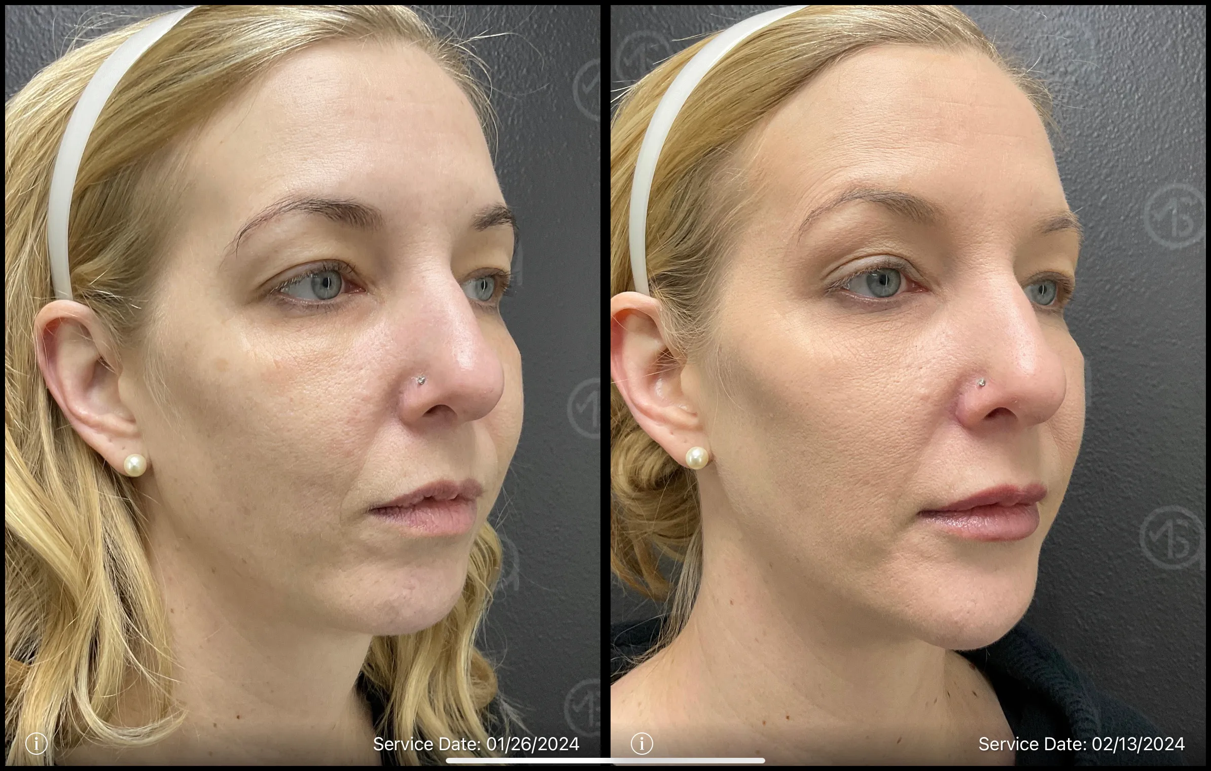 Clear skin | Before and After | ANEU Medical Spa | McFarland | Madison, WI