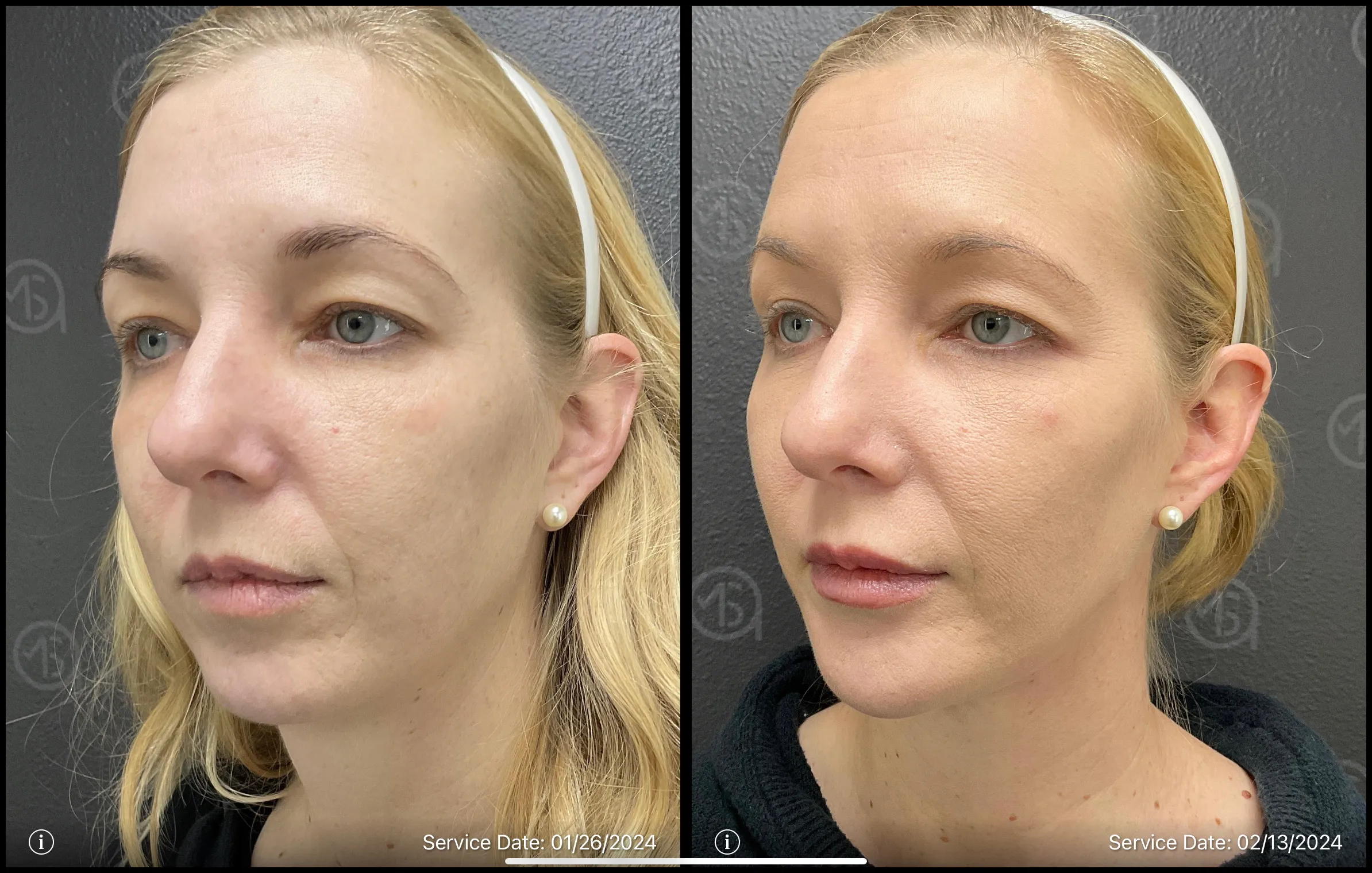 acne therapy | before and after | ANEU Medical Spa | McFarland | Madison, WI
