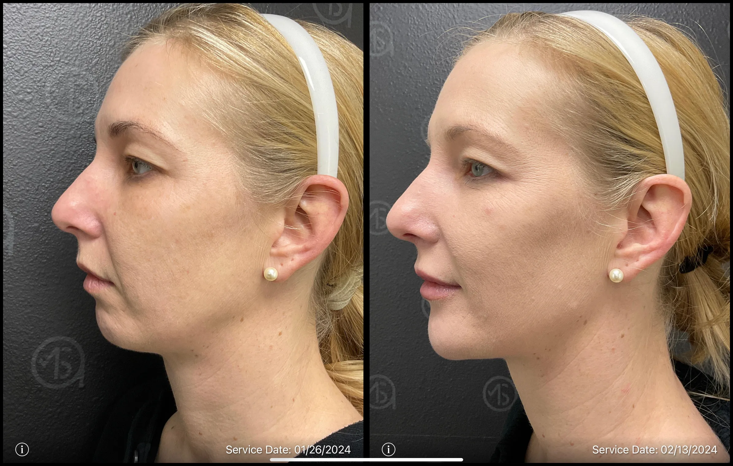 acne therapy for face | before and after | ANEU Medical Spa | McFarland | Madison, WI