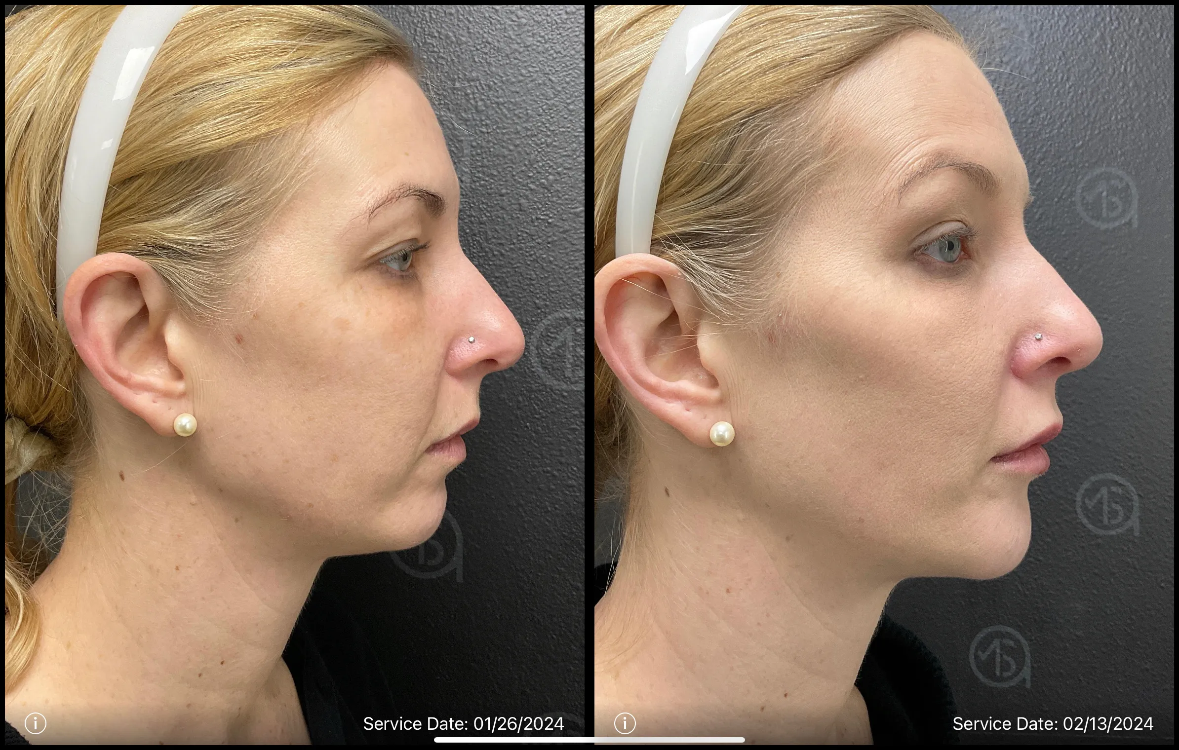 Clear skin treatment | before and after | ANEU Medical Spa | McFarland | Madison, WI
