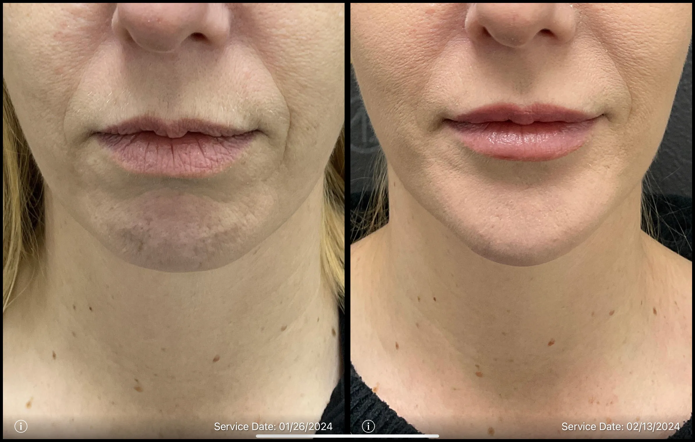 lip lines treatment | before and after | ANEU Medical Spa | McFarland | Madison, WI