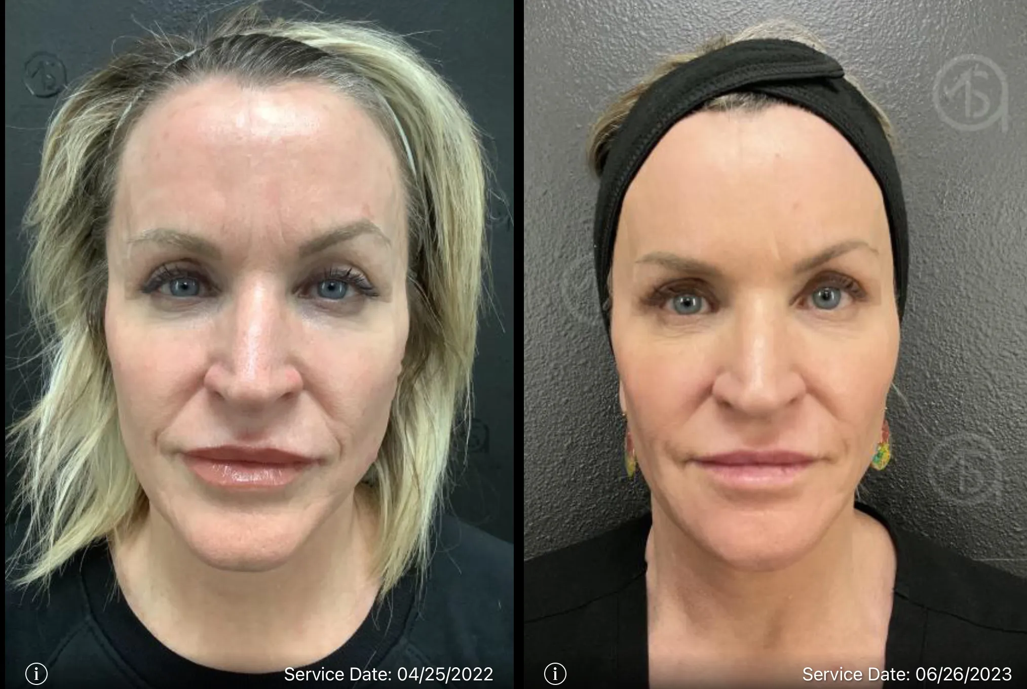 Lip shape augmentation | before and after | ANEU Medical Spa | McFarland | Madison, WI