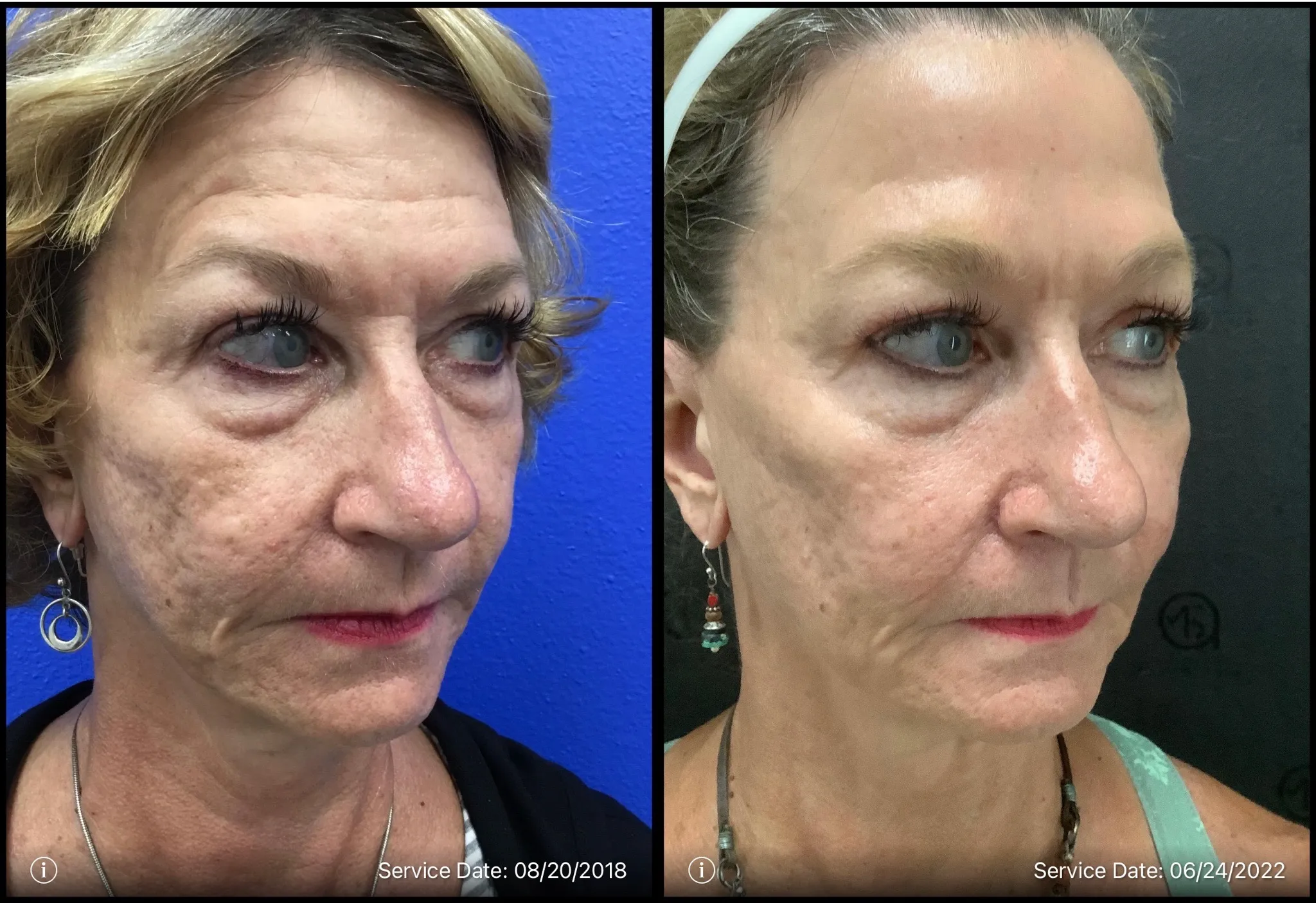 Skin texture | before and after | ANEU Medical Spa | McFarland | Madison, WI
