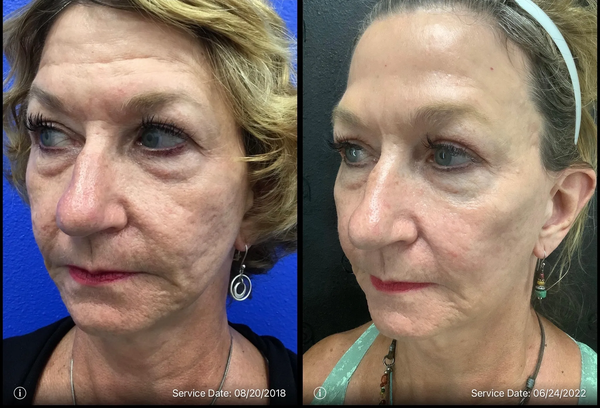 Wrinkles reduction from face | before and after | ANEU Medical Spa | McFarland | Madison, WI