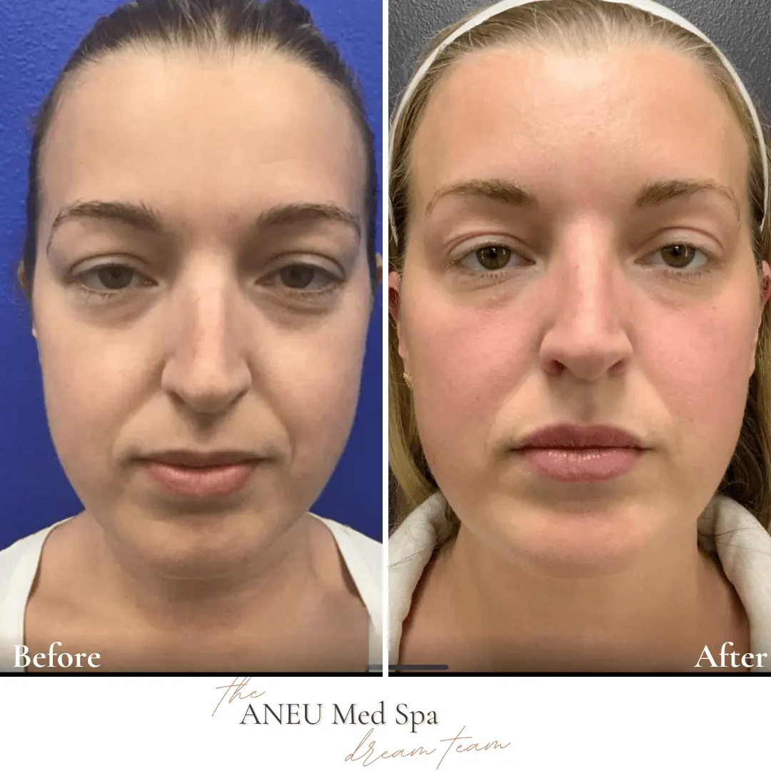 Before and After Total Transformation in McFarland, WI | ANEU Medical Spa McFarland, WI