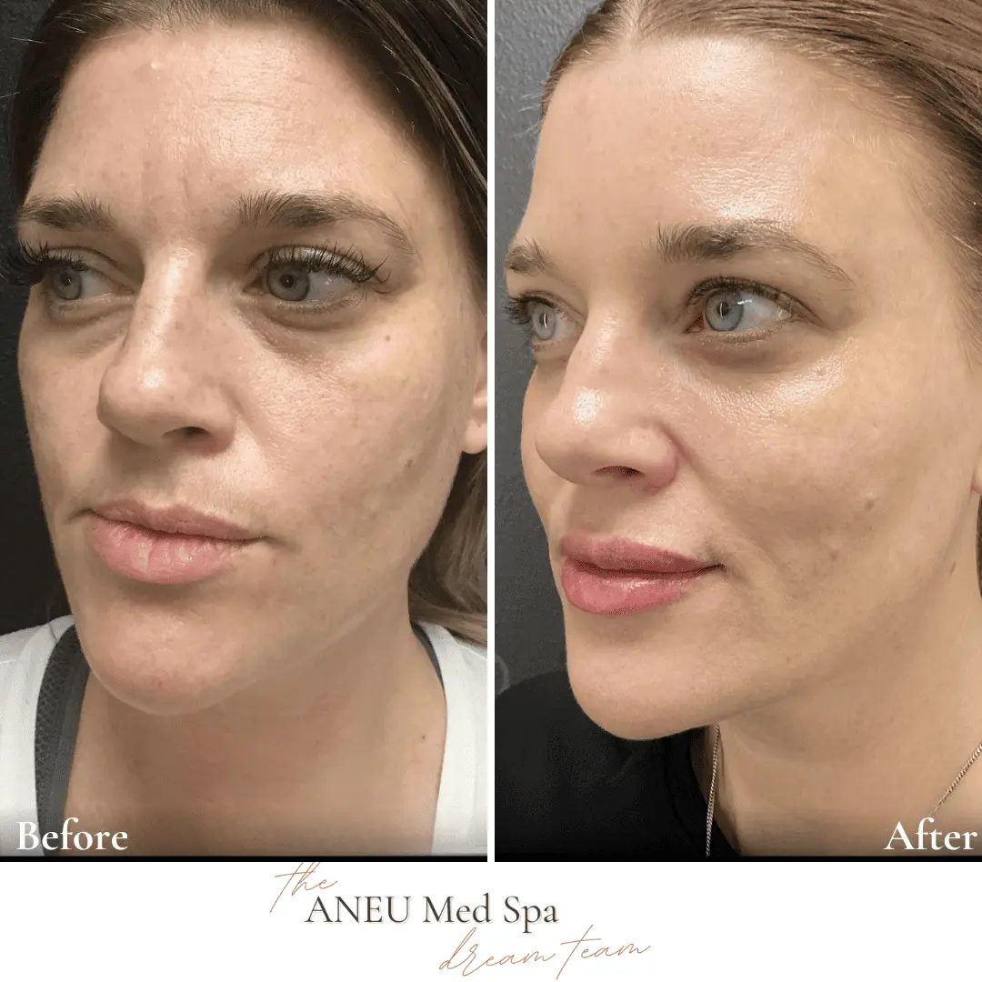 Before and After Total Transformation in McFarland, WI | ANEU Medical Spa McFarland, WI